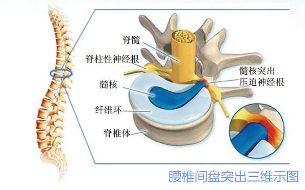 腰椎間盤突出