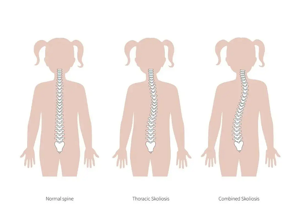 脊柱側彎