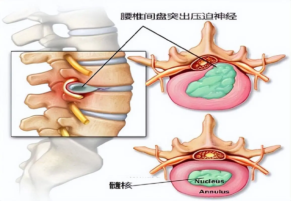 腰椎間盤突出