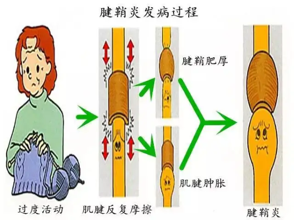 腱鞘炎發病過程