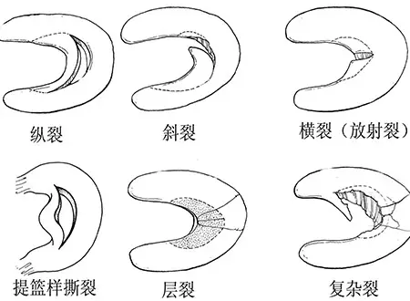 半月板損傷