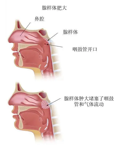 腺樣體肥大