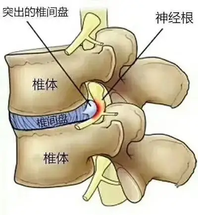 腰椎間盤突出