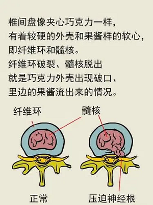 腰椎間盤突出