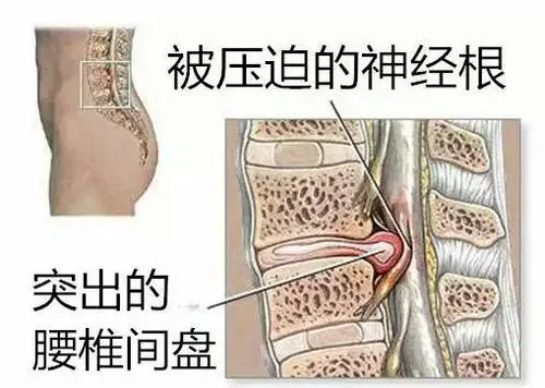 腰椎間盤突出示意圖