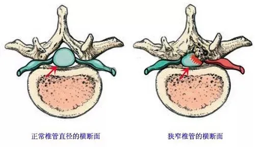 正常椎管和椎管狹窄橫斷面對(duì)比圖