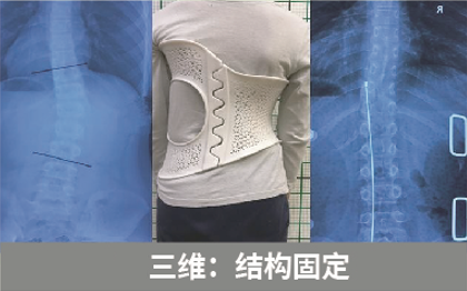 直樂六維脊柱側彎矯形——結構固定