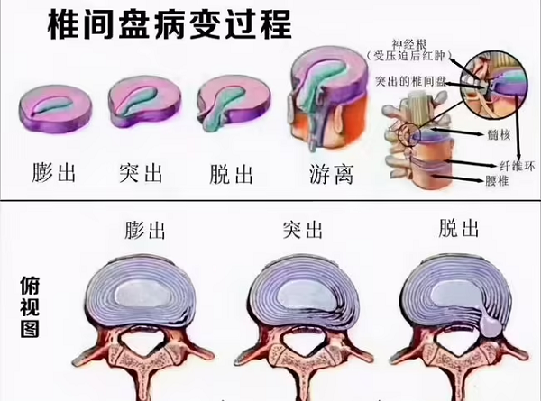 椎間盤病變過程