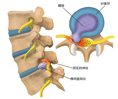 椎間盤突出示意圖