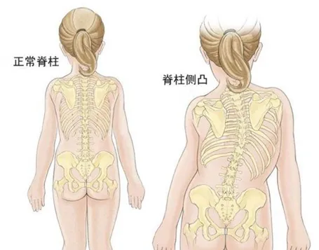 正常脊柱和脊柱側(cè)彎對比