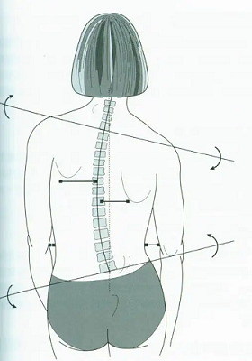 脊柱偏離中線