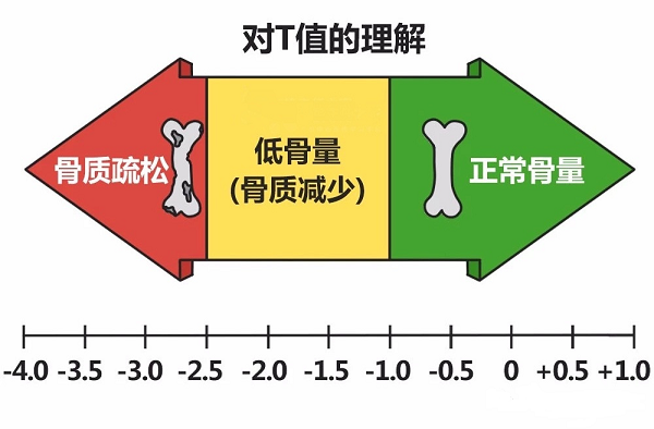 骨密度檢測(cè)中T值的理解