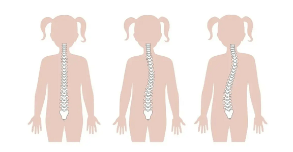 脊柱側(cè)彎對(duì)比圖
