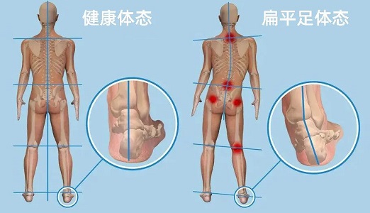 扁平足體態和健康體態對比圖