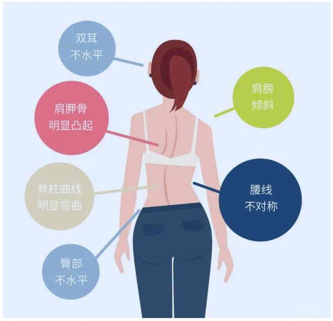 脊柱側彎典型外觀特征