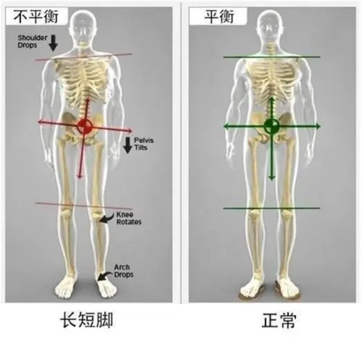 脊柱側(cè)彎長短腿