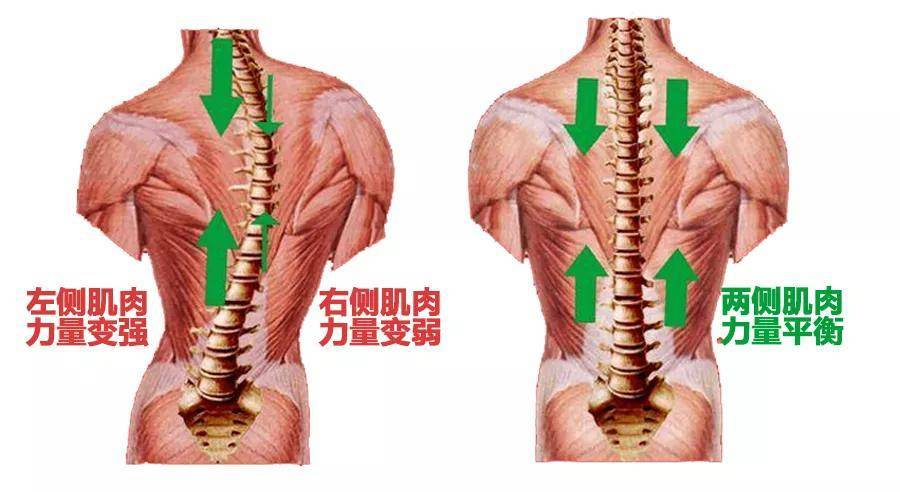 脊柱側彎和常人肌肉力量差異