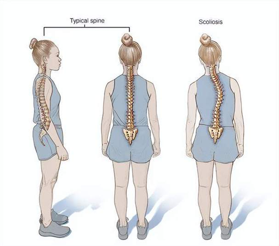 常人和脊柱側(cè)彎的差別