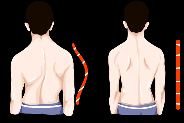 脊柱側(cè)彎背部特征