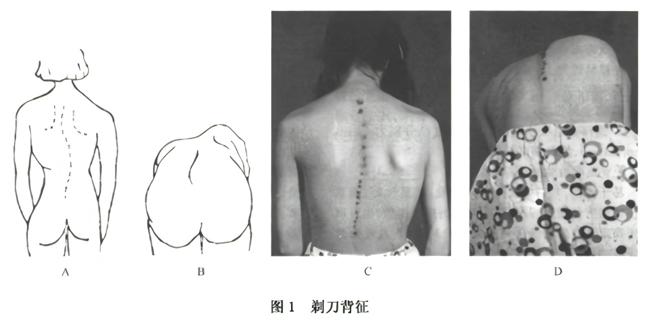 脊柱側彎剃刀背特征