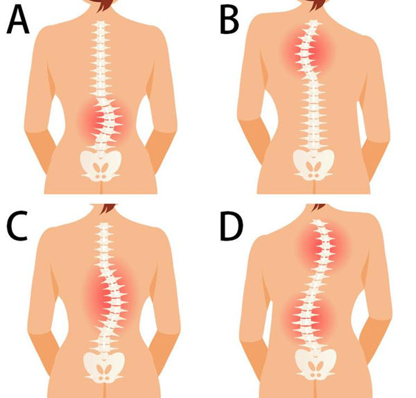 脊柱側(cè)彎按側(cè)彎位置分的類型