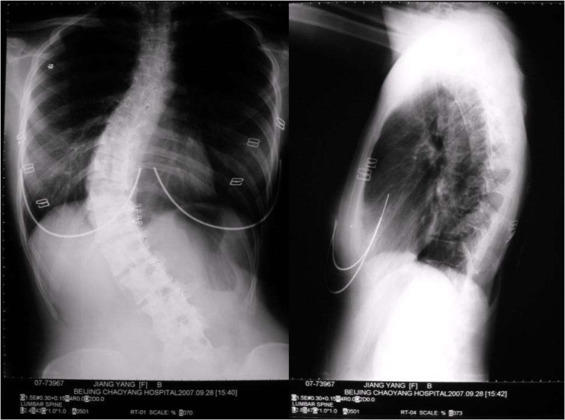 脊柱側彎圖像