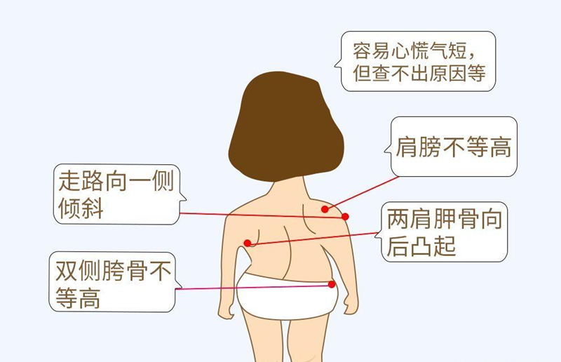 脊柱側(cè)彎典型癥狀