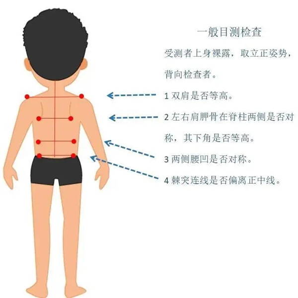 脊柱側(cè)彎居家自測方法