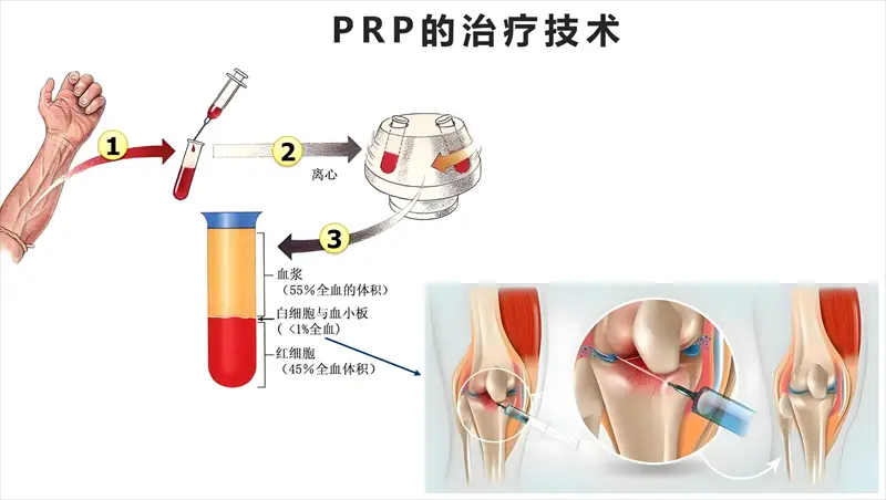 關節prp