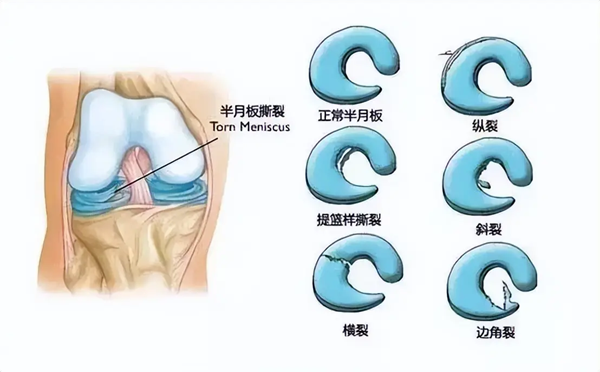 半月板撕裂