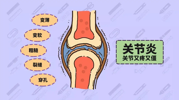 關節炎癥狀